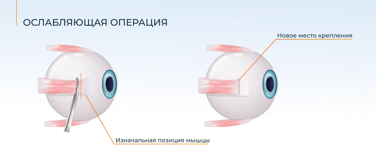 ослабляющая операция по косоглазию