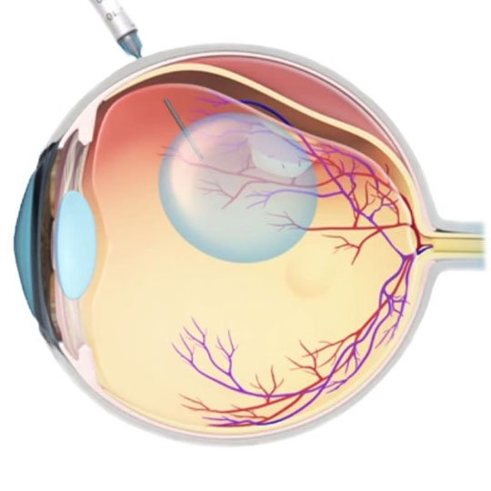 Пневматическая ретинопексия