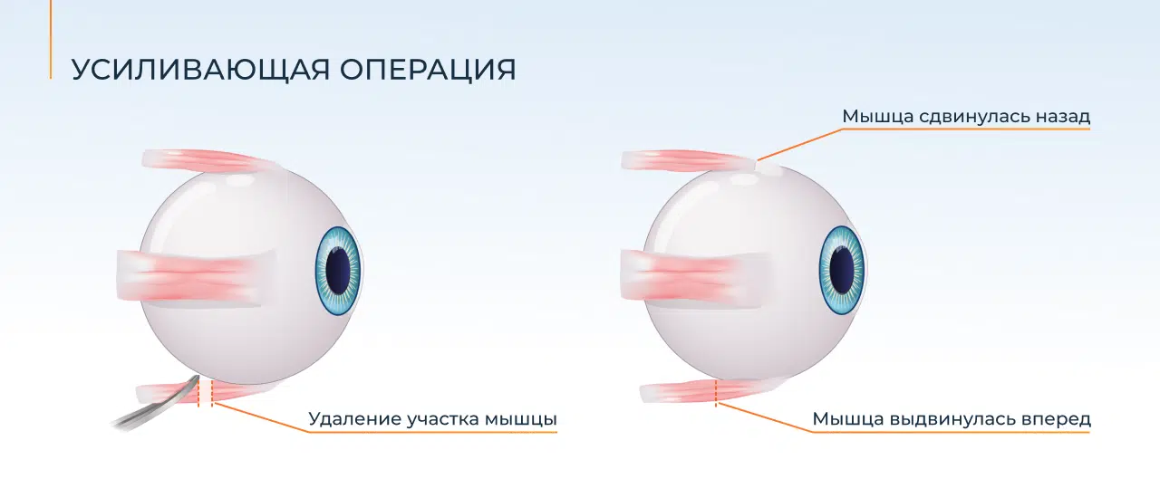усиливающая операция по косоглазию