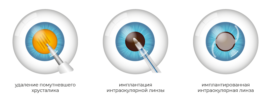операция факоэмульсификация катаракты