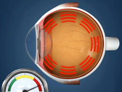 Глаукома, повышение внутриглазного давления