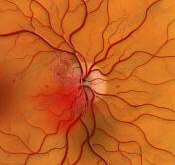 Профилеративная ретинопатия