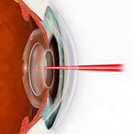 Лечение вторичной катаракты